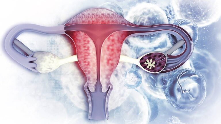 Eliminar quistes y miomas naturalmente