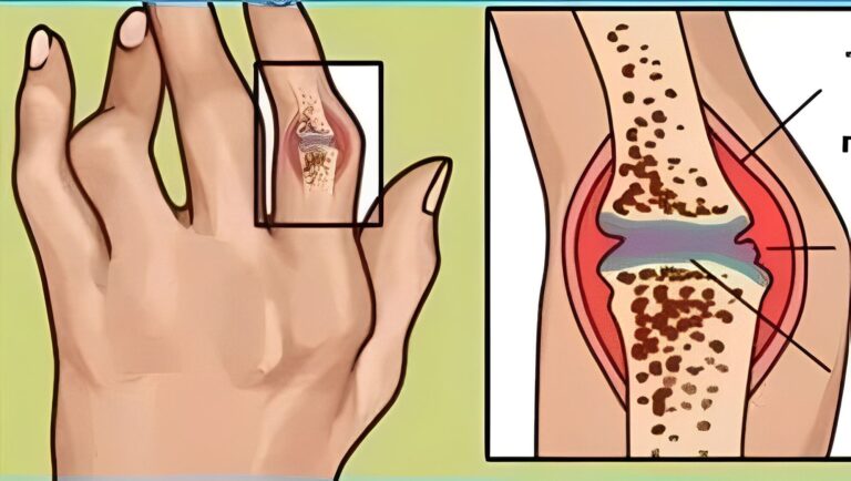Infusión para la artritis