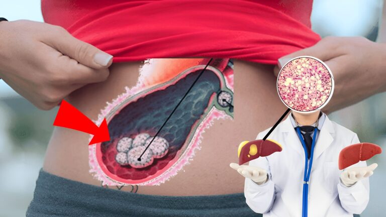 Remedio para limpiar el hígado y eliminar las piedras de la vesícula