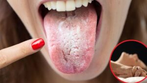 Consejos para prevenir el virus del papiloma humano