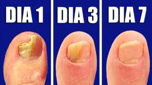 Remedios caseros para eliminar los hongos de las uñas