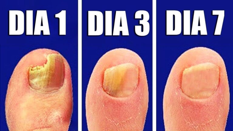 Remedios caseros para eliminar los hongos de las uñas