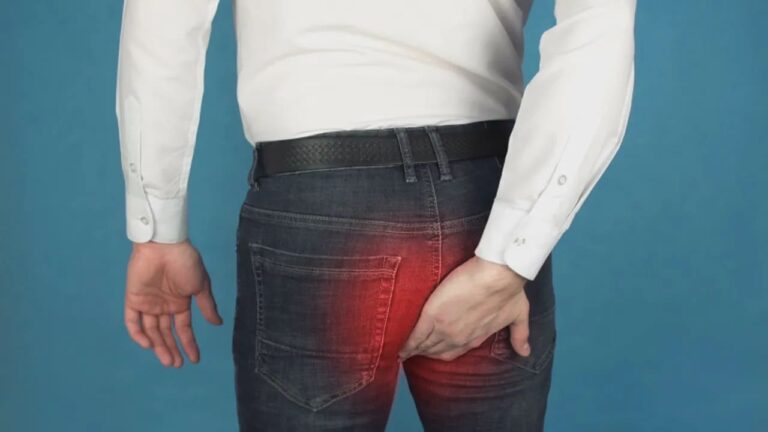 Remedios caseros para las hemorroides