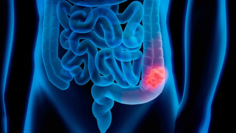 5 síntomas de cáncer de colon