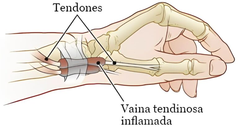 Todo sobre la Tenosinovitis
